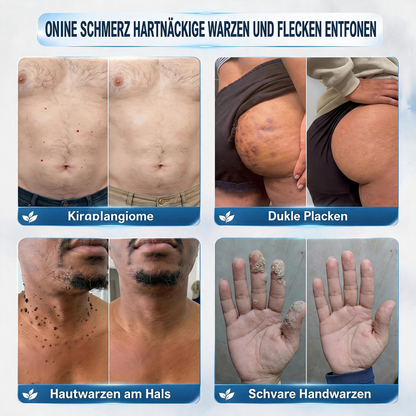 Offizieller Markenstore |✅Natravor® 7-𝑻𝒂𝒈𝒆 𝑯𝒂𝒖𝒕𝒂𝒏𝒉ä𝒏𝒈𝒔𝒆𝒍- & 𝑭𝒍𝒆𝒄𝒌𝒆𝒏𝒆𝒏𝒕𝒇𝒆𝒓𝒏𝒆𝒓(Schmerzfreier Rollerball – Keine Narbenbildung)🚀